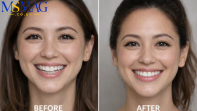 lip flip before and after